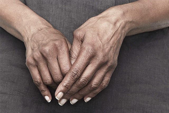 DR. ARTHRITIS EXPLAINS: THE MOST COMMON ARTHRITIS MYTHS EXPLAINED - Dr. Arthritis