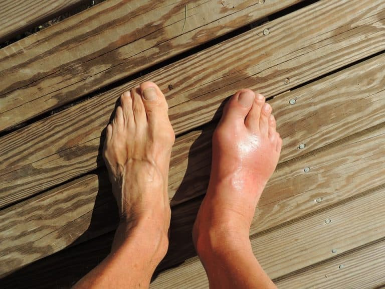 INFLAMMATORY CONDITIONS: THE DIFFERENCE BETWEEN GOUT AND ARTHRITIS - Dr. Arthritis