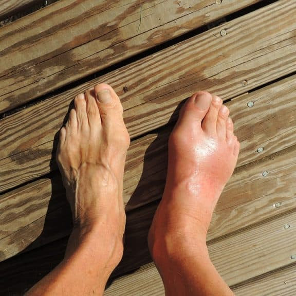 INFLAMMATORY CONDITIONS: THE DIFFERENCE BETWEEN GOUT AND ARTHRITIS - Dr. Arthritis